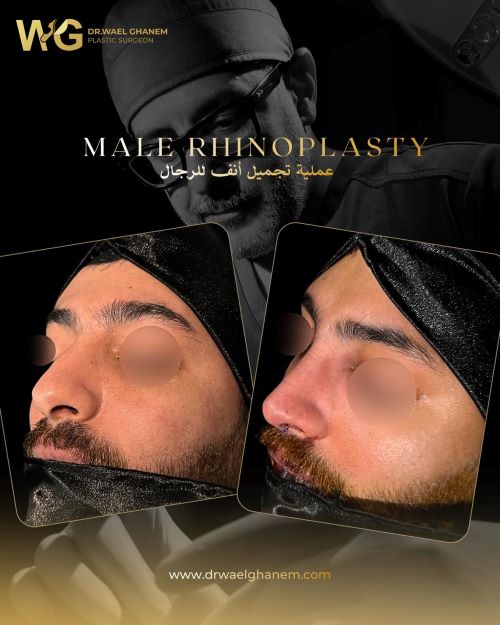 افضل دكتور تجميل انف في مصر